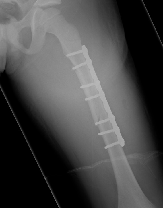 Paediatric Femoral Fracture Plate